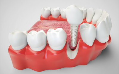 Implante dental, ¿qué es y en qué consiste?