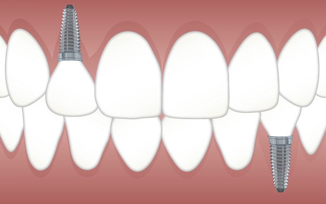 Tipos de prótesis dental
