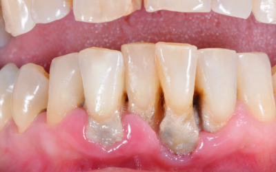Estadios de la periodontitis y tratamiento