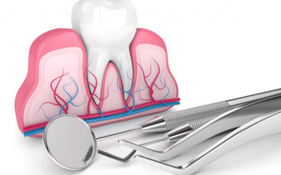 Qué es una endodoncia y en qué consiste
