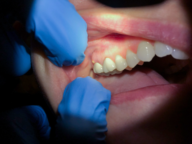 qué es un absceso dental