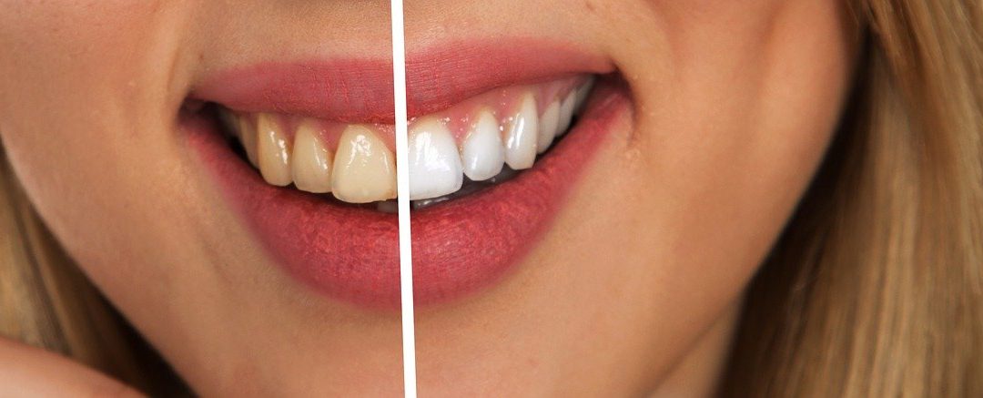El blanqueamiento dental es uno de los tratamientos estéticos más demandados en Clínica Dental Oris en Zafra