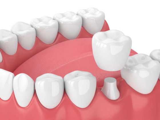 qué son las coronas dentales