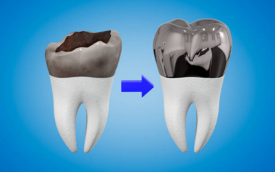 Qué son las coronas dentales y en qué casos están indicadas