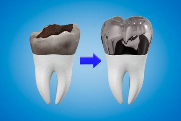 Qué son las coronas dentales y en qué casos están indicadas