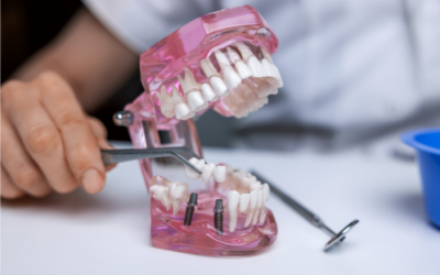 Qué es un puente dental: tipos y características