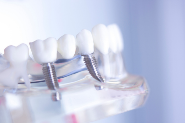 puentes dentales vs implantes 