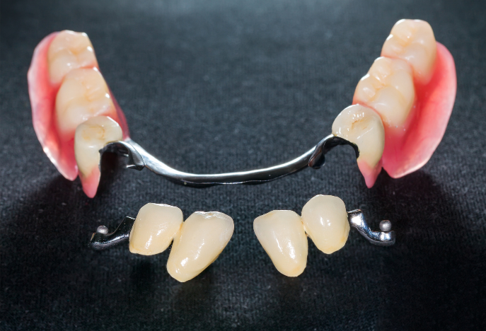Conoce las ventajas e inconvenientes del uso de prótesis dental removible