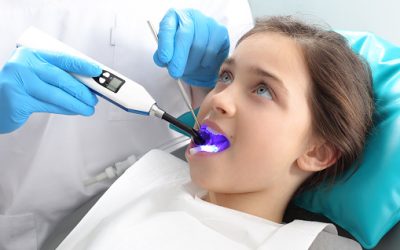 Para qué sirven los selladores dentales y qué beneficios tienen