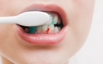 Sangrado de Encías: Causas, Prevención y Consejos Dentales