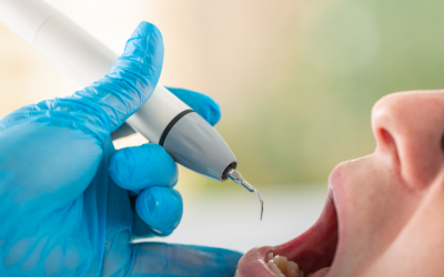 ¿Por qué se forma sarro en los dientes y cómo prevenirlo?
